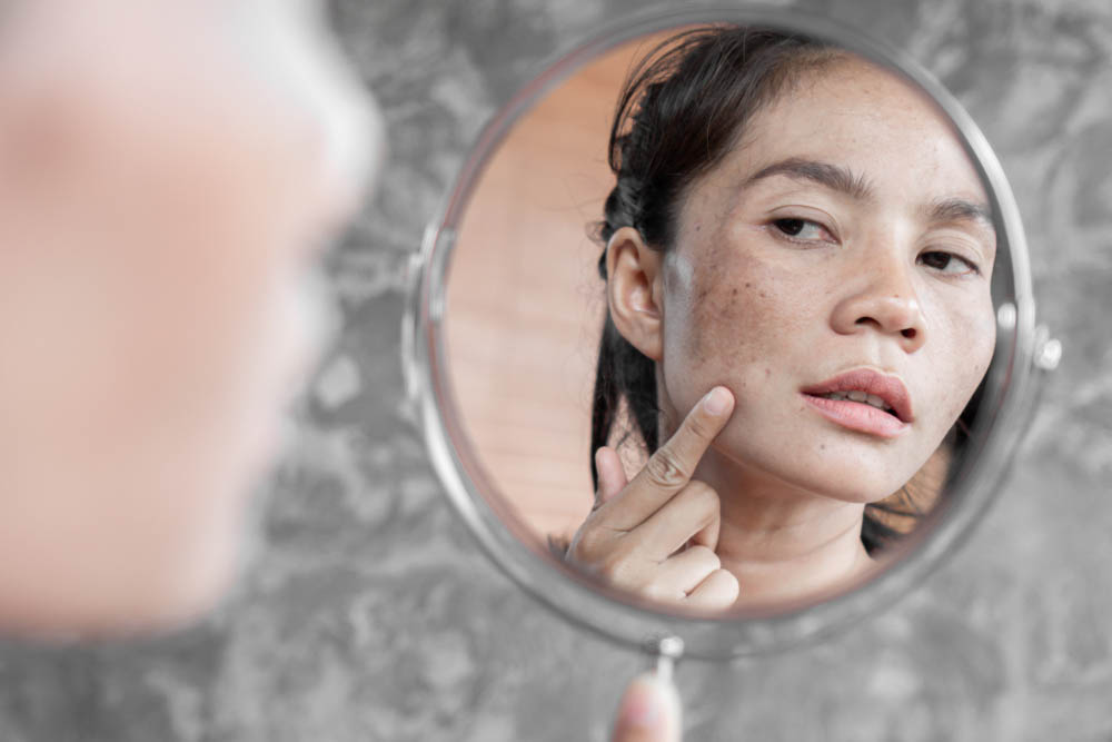 Hva kan du gjøre med pigmentflekker i ansiktet?